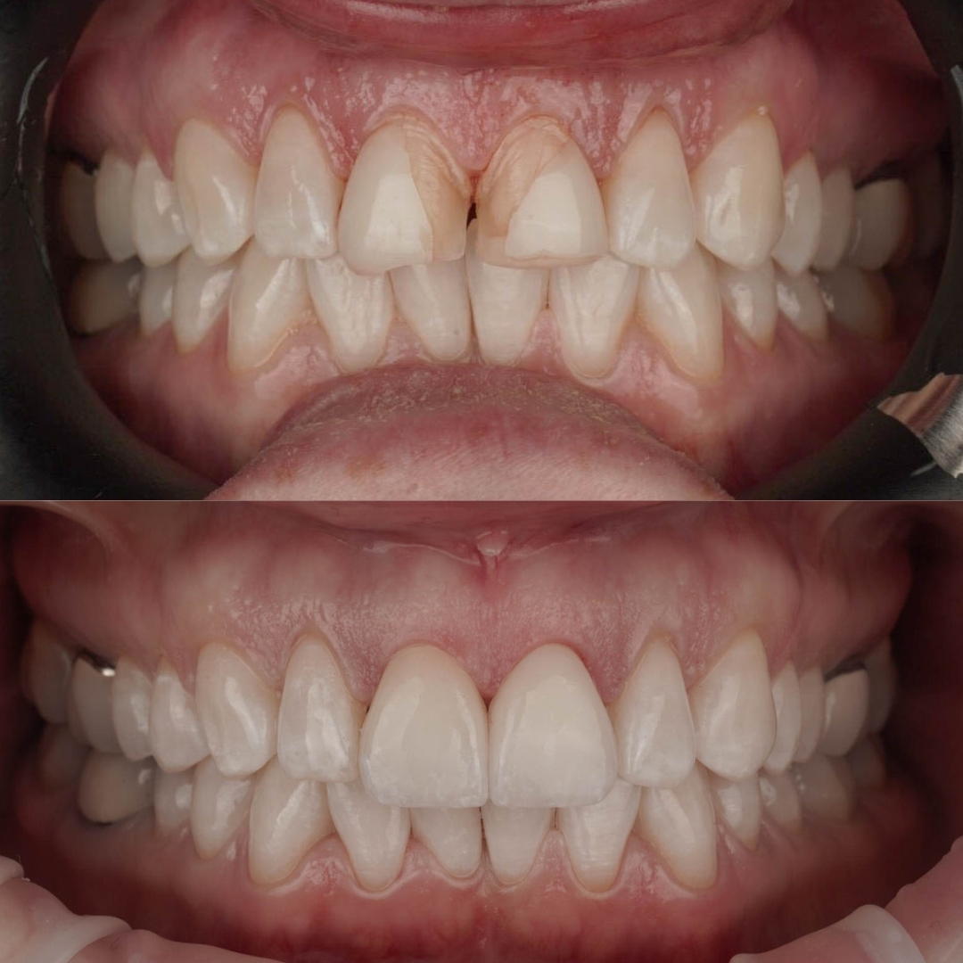 Before and after custom porcelain veneers transformation